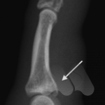 Distal phalanx and PIPJ fracture dislocation