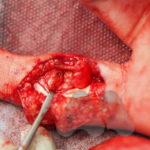 Hemi-hamate autograft reconstruction of dorsal PIPJ fracture dislocation