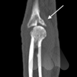 PIPJ dorsal fracture dislocation