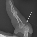 Volar PIPJ dislocation
