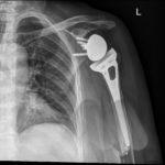 Reverse total shoulder replacement