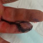 Cross finger flap reconstruction of fingertip amputation