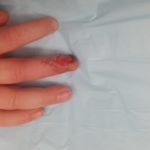 Fingertip amputation in a child