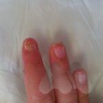 Healed fingertip amputation in a child