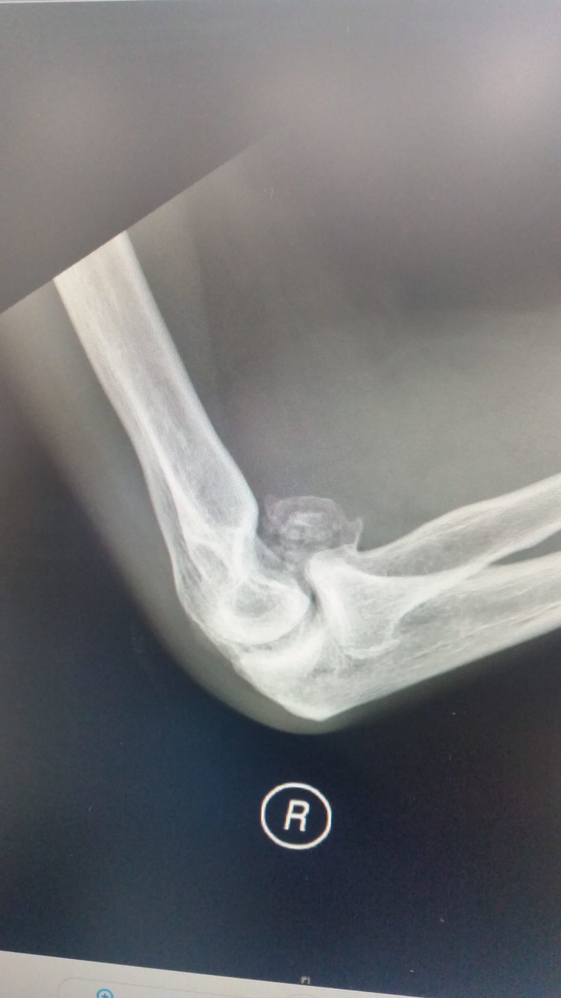 Stiff Elbow and osteoarthritis Avanthi Mandaleson