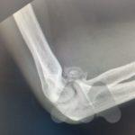 Elbow osteoarthritis and loose bodies on lateral X-Ray