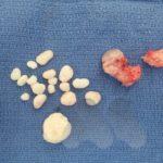 Loose bodies removed from elbow after debridement