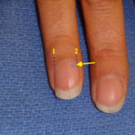 Sub-ungal glomus tumour with bluish discolouration under the nail