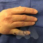 Large mucous cyst 3