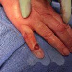Large mucous cyst with skin excision and local skin rotation flap