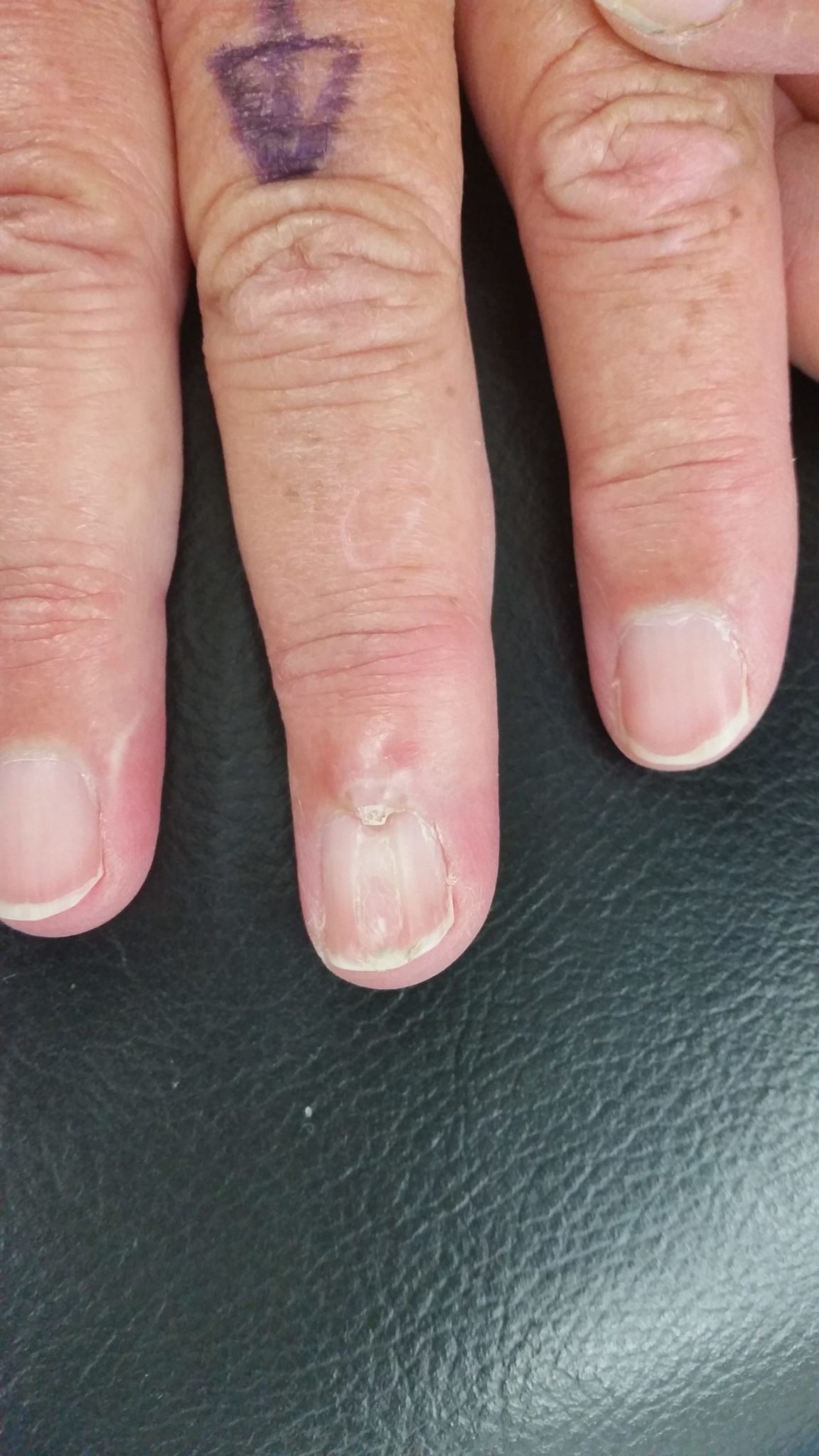 Mucous Cysts Avanthi Mandaleson mucous-cysts-avanthi-mandaleson