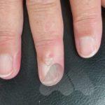 Small mucous cyst with nail ridging