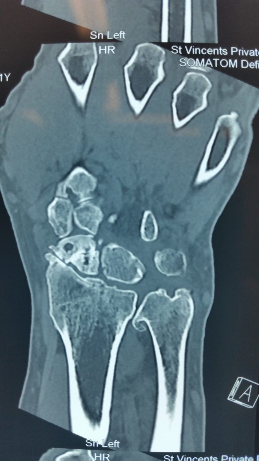 Scaphoid fractures Avanthi Mandaleson