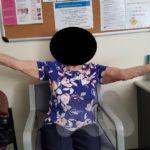 Movement after total elbow replacement