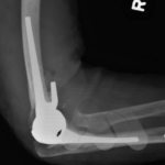 Total elbow replacement