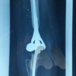 Total elbow replacement
