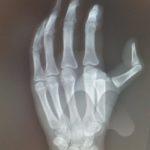 Thumb MP dislocation XR 1 AM