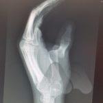 Thumb MP dislocation XR 2 AM