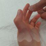 Thumb MP dislocation clinical 2 AM