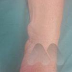 Volar wrist ganglion 1 AM