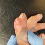 DIP joint gout