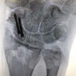 Two screw fixation scaphoid fracture