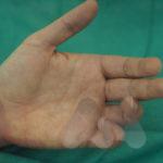 Ulna neuropathy from cubital tunnel syndrome