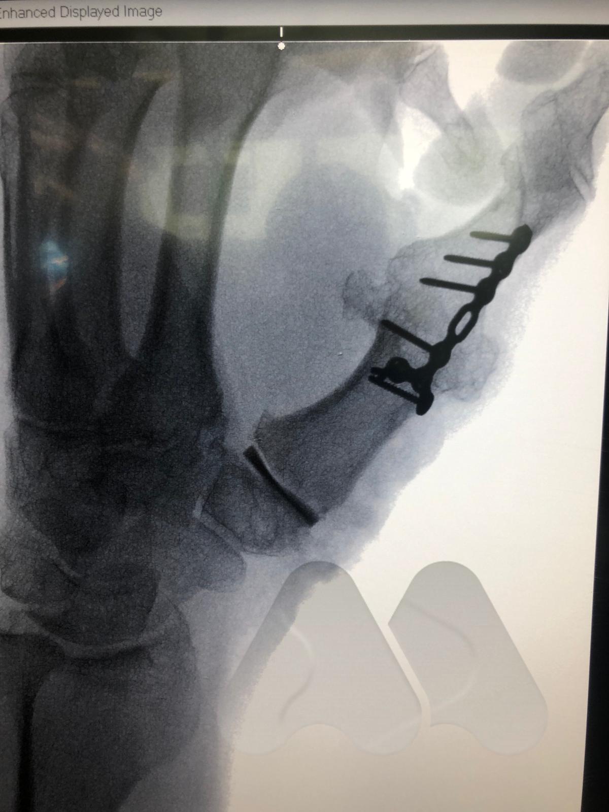 Thumb MCP joint fusion and CMC joint interposition joint rep[lacement (Pyrocardan)