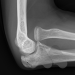 Radial head dislocation