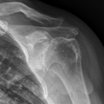 Primary shoulder osteoarthritis