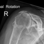 Rotator cuff arthropathy
