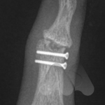 Osteonecrosis and arthritis DIP joint