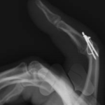 Index finger PIP joint fusion