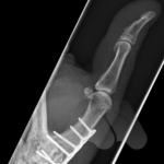 Thumb CMC fusion