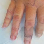 Rotational flap for large mucous cyst