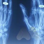 Thumb CMC joint arthritis