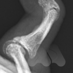 PIP joint post traumatic osteoarthritis