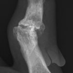 PIP joint post traumatic osteoarthritis