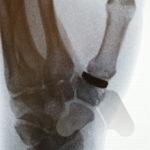 Thumb CMC joint interposition joint replacement (Pyrocardan)