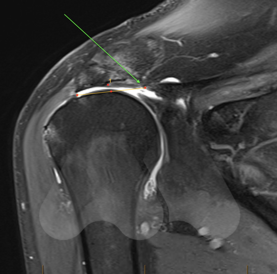 Massive rotator cuff deals tear