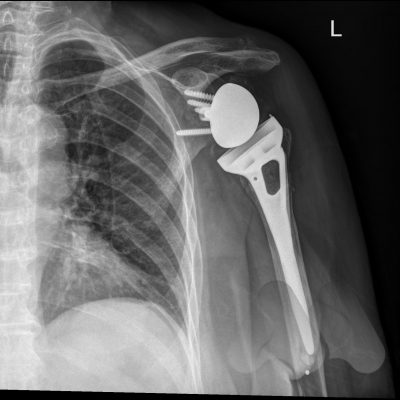Reverse total shoulder replacement