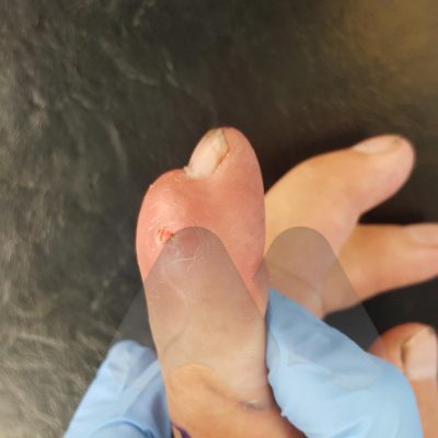 DIP joint gout