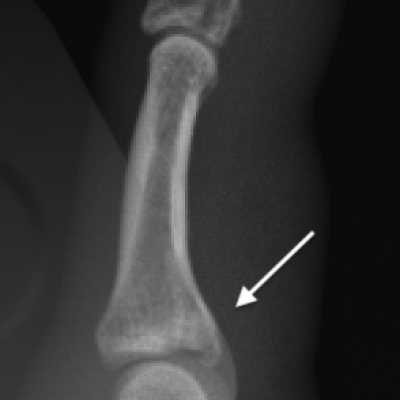 Distal phalanx and PIPJ fracture dislocation