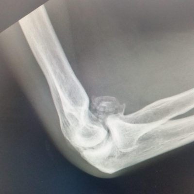 Elbow osteoarthritis and loose bodies on lateral X-Ray