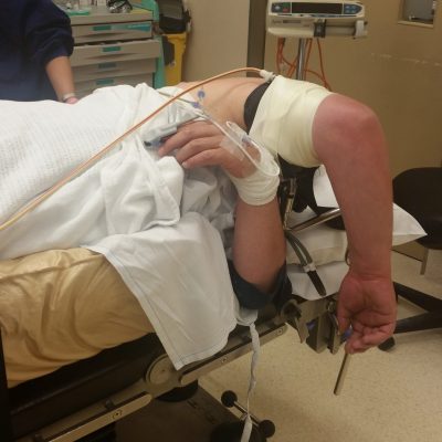 Elbow arthroscopy theatre positioning and setup