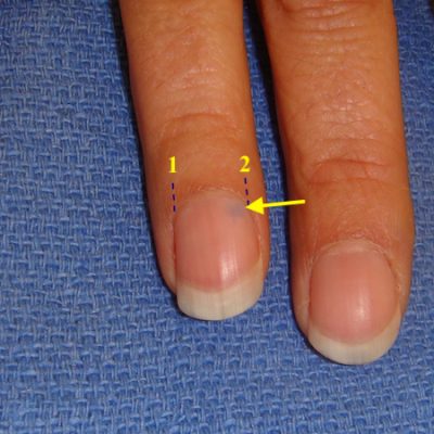 Understanding Paronychia: Fingernail Infection - Raleigh Hand to Shoulder  Center | Raleigh Hand to Shoulder Center