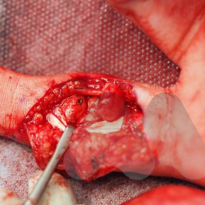 Hemi-hamate autograft reconstruction of dorsal PIPJ fracture dislocation