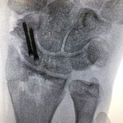Two screw fixation scaphoid fracture