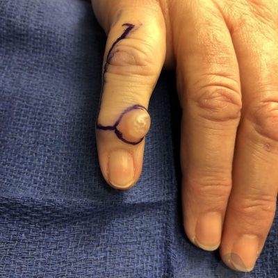 Large mucous cyst