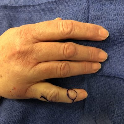 Large mucous cyst 3